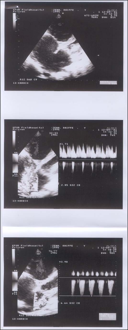 ECHO cardiogram, from KFOR Hospital Commander LtCol Dr. J.Hohmann