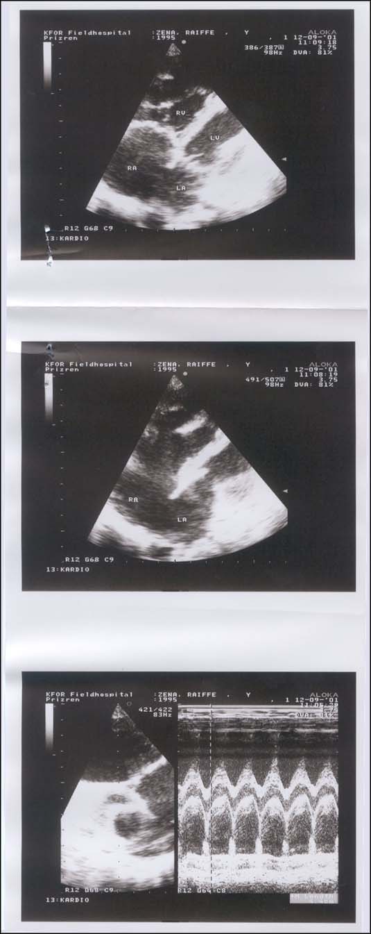 ECHO cardiogram, from KFOR Hospital Commander LtCol Dr. J.Hohmann