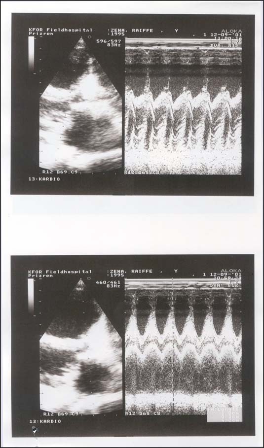 ECHO cardiogram, from KFOR Hospital Commander LtCol Dr. J.Hohmann